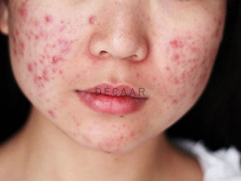 Mụn trứng cá bọc